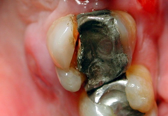 How Dentist Treat the Longitudinal Tooth Cracks and Fracture Issues