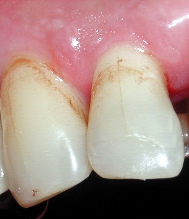 Craze Lines on Teeth  Enamel Craze Lines Treatment in Toronto
