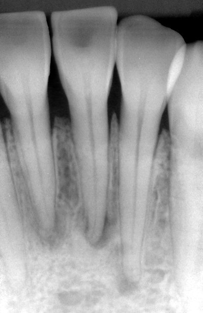 Early stage of periapical cemental dysplasia.